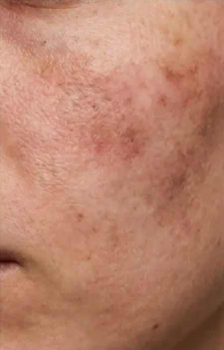 Uneven skin tone