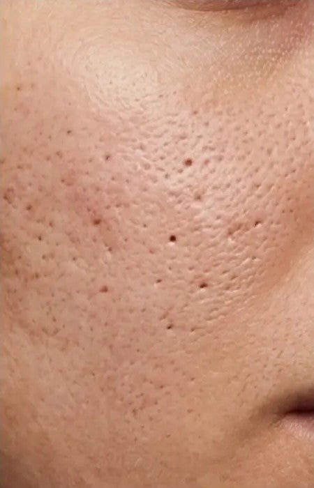 Clogged pores